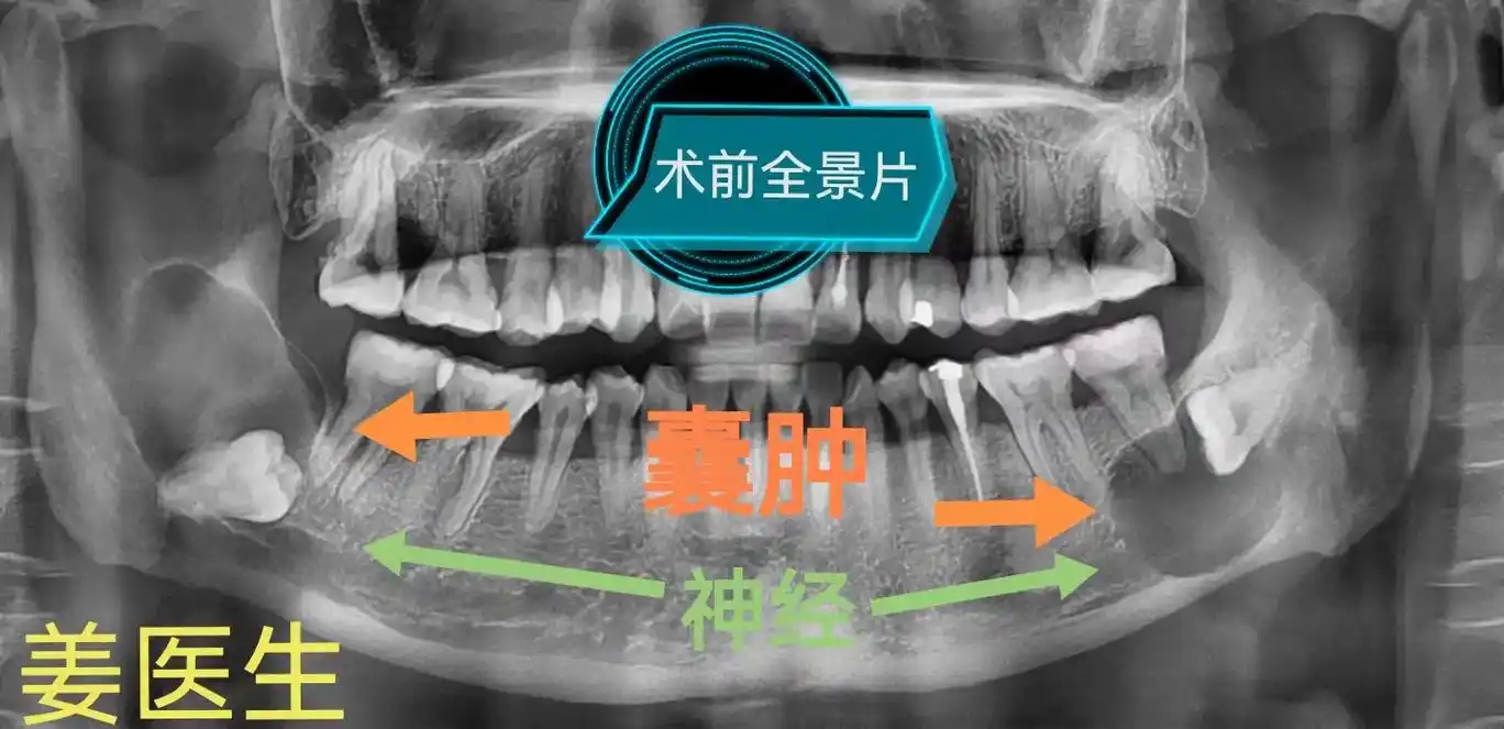 双侧下颌骨囊肿局麻下同时完成.大部分"颌骨囊肿"均可门诊局麻 - 抖音