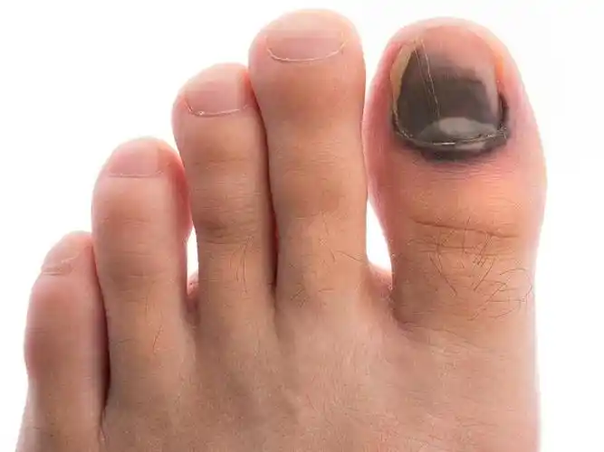 灰指甲初期样子图片轻微_小强知识网