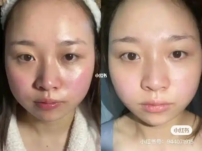 敏感肌修复实录