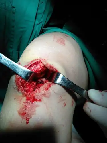 胫骨髁间嵴撕脱骨折的治疗