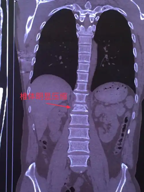 微创手术系列二.《经皮椎弓根钉治疗腰1压缩性骨折》