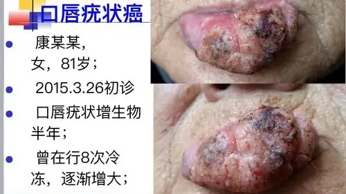 病例分享:口唇疣状癌 - 好大夫在线