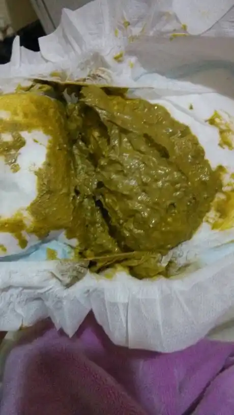 不要闲恶心,宝宝拉的这屎是怎么回事?很臭,宝宝才两个月零十天