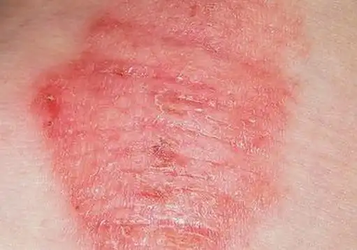 亚急性湿疹的临床特点是什么