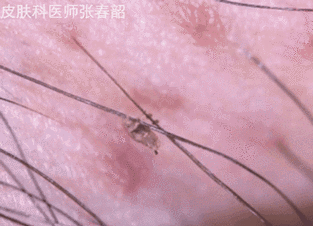 "没有性生活,裤裆里长了虫,痒到我把蛋皮都抓破了"_阴虱_毛发_治疗