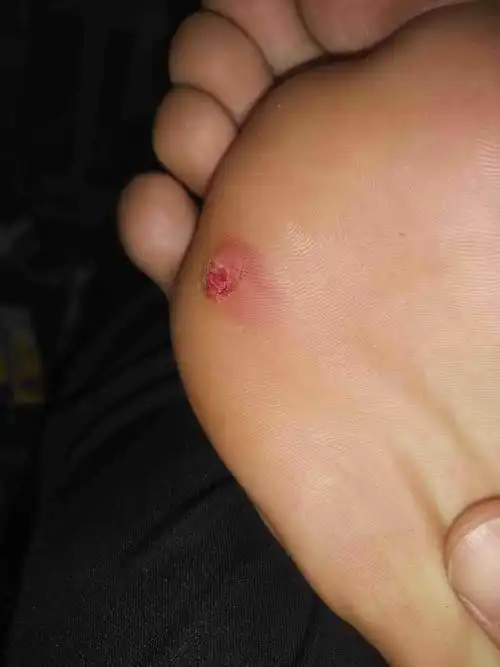 钉子扎脚俩月,肉里起硬块了,这个怎么处理!一碰就疼!