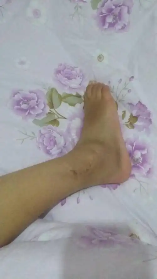 年前不小心崴脚,致使右脚后踝,外踝骨折,内固定手术后石膏固定了3个