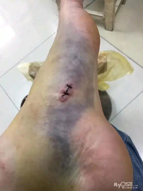 这张照片是当时缝针的部位,现在开刀部位是脚底