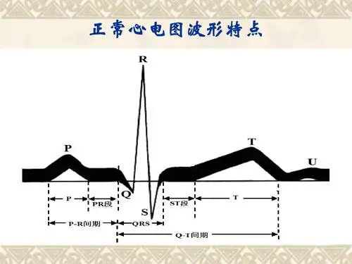 护理人员常见异常心电图的识别及处理方法 - 副本ppt