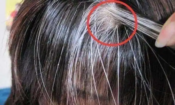 现在越来越多的年轻人都长出了白头发,特别是局部白