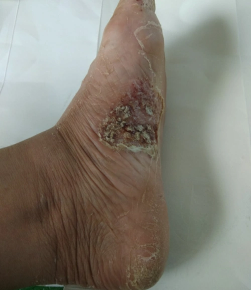 请大家帮帮忙!母亲脚起脓包,后来不断扩散.烤电,抹药膏,都不好使._百