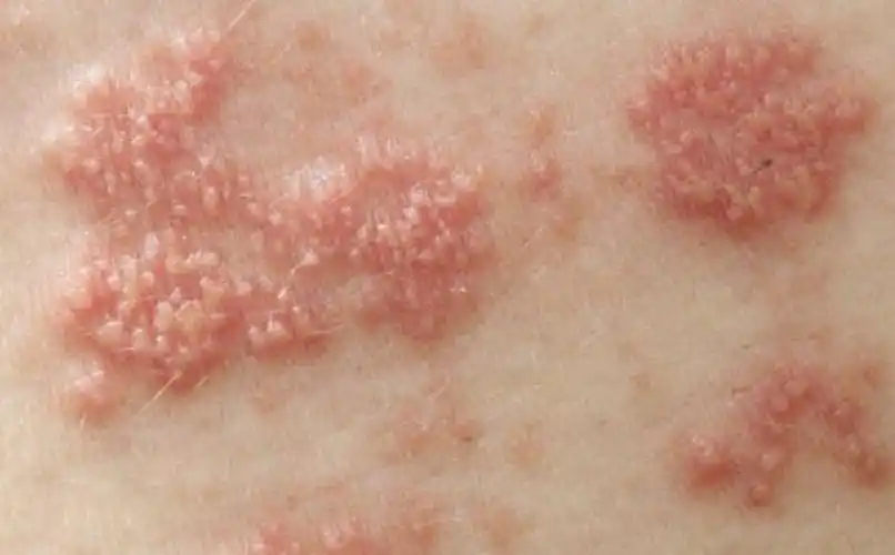 北京皮肤癌专家_北京治疗皮肤癌哪个专家好_北京治疗皮肤癌最好的专家