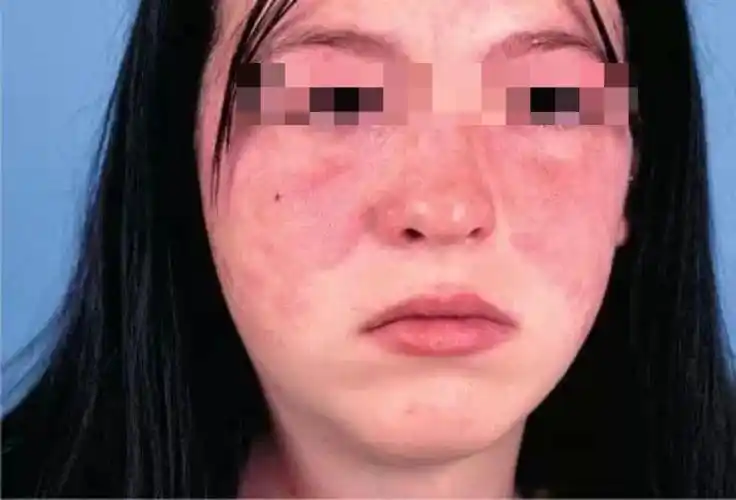 目前,中国约有109万系统性红斑狼疮患者,以15—45岁的中青年女性为主