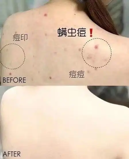 枕头睡久了容易滋生螨虫?教你一个小诀窍,有效去除螨虫