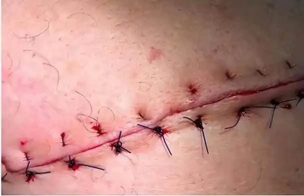 经脐单孔腹腔镜阑尾切除术让你无忧炫"腹"|阑尾|手术|腹腔镜_新浪新闻