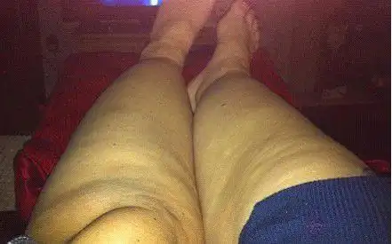 英国女子患病双腿粗壮如树干 曾以为是因肥胖(图)