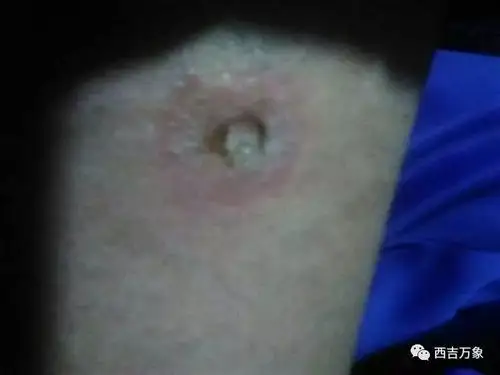 昨日傍晚,西吉田坪乡一学生回家路上被"电猫"击中,腿部被打了好几个洞