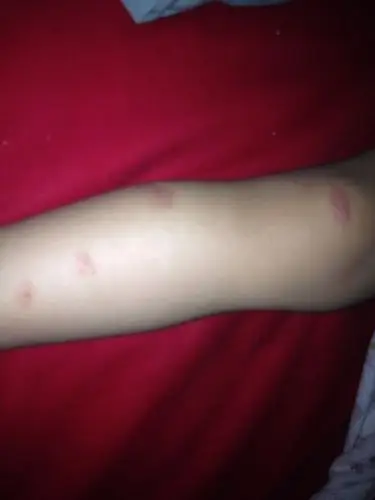 问:两周岁女宝宝最近几天腿上起了好多红色的一片一片的 还特别痒