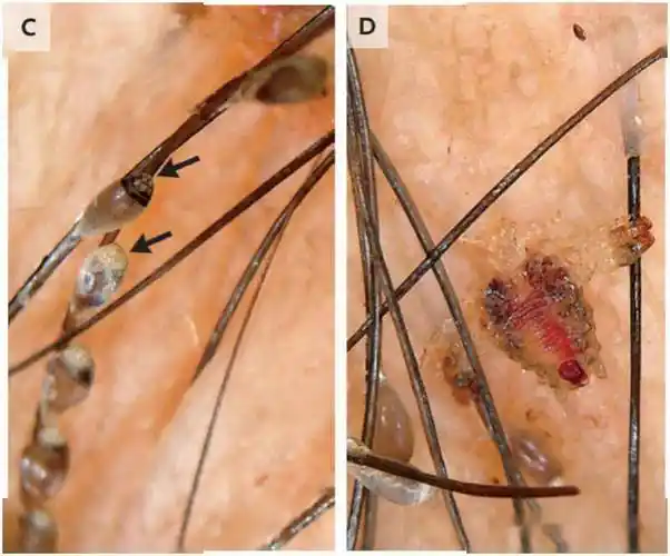 广州专家用皮肤镜捕捉到传染性皮肤病阴虱致病全过程_临床_外阴_影像
