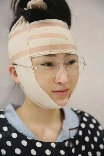 拉皮手术提升术后3天_smas除皱术术后3天_紧致提升术后3天_除皱抗衰老