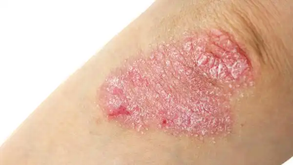 鱼鳞病能治愈吗鱼鳞病的治疗方法都有哪些