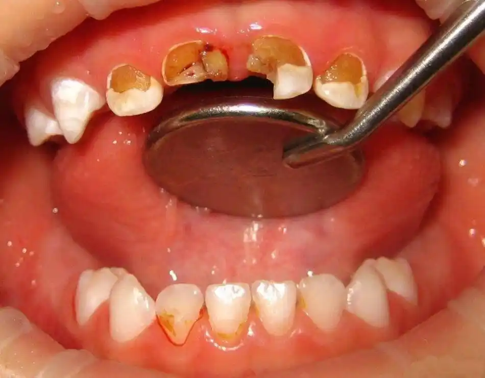 门牙蛀掉了一块怎么办