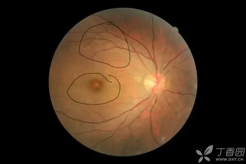 特发性脉络膜新生血管. [病例帖]