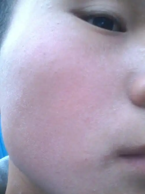 我脸上长得这是什么啊?是癣吗?要怎么治疗?