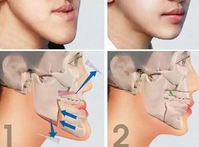 地包天改如何矫正呢