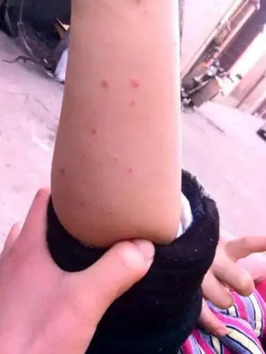 我儿子5岁了得了过敏性紫癜,症状是肚疼的厉害,住了半个月院好了!