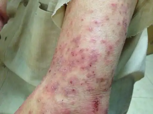 老人身上起了湿疹,非常厉害,中药也吃了一年多了,基本没用,各种药品都