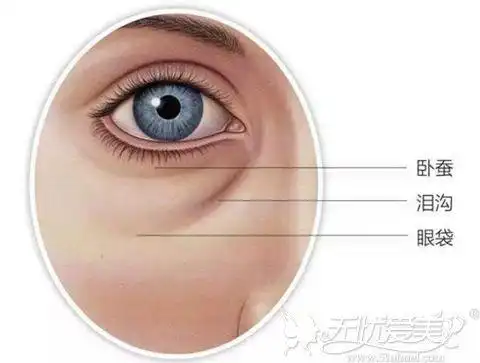 袋状结构,形成方面可以由于先天的遗传因素造成,先天下眼窝脂肪比较多