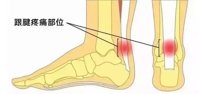 疼痛部位:脚后跟后面一直到腓肠肌之间的位置感到疼痛.
