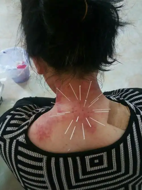 富贵病,颈椎病.我来把她慢慢消除掉,针灸针,用心调.