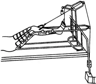 图6-6-18 股骨干骨折骨牵引法5.