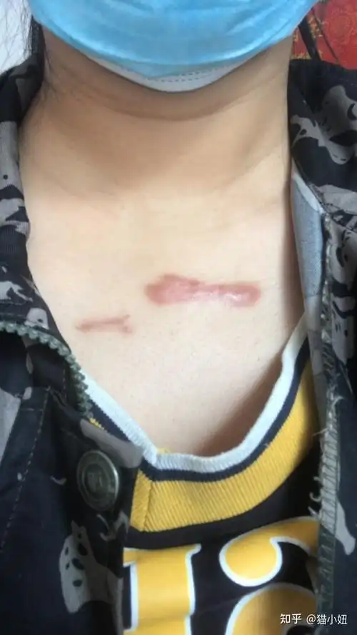 疤痕疙瘩胸前增生性疤痕疙瘩去疤记录中