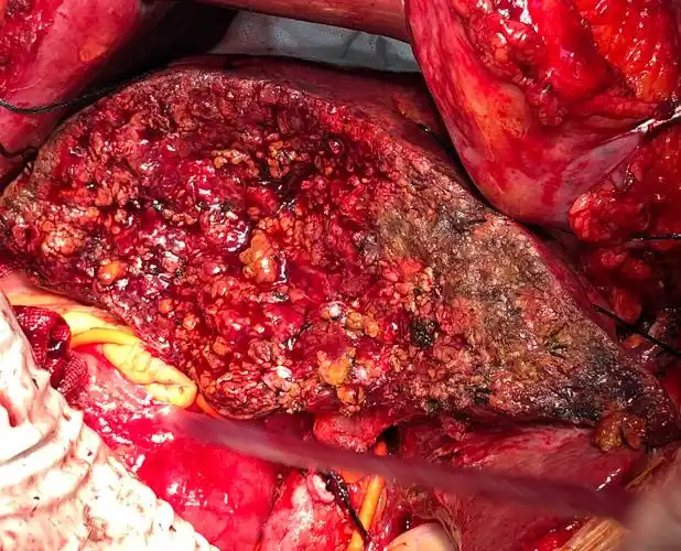 原发性肝癌的一线治疗方案(一)——原发性癌_【吉康旅】