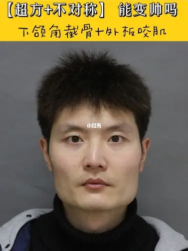 很方的国字脸|下颌角截骨 去外板会变帅吗_下颌角_咬肌_脸型_磨骨_我