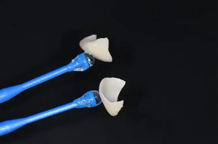 瓷贴面修复--奥美口腔韦医生