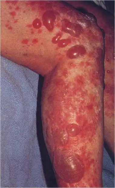 艾滋病前兆有哪些症状『艾滋病前兆有哪些症状几天可以感觉到』