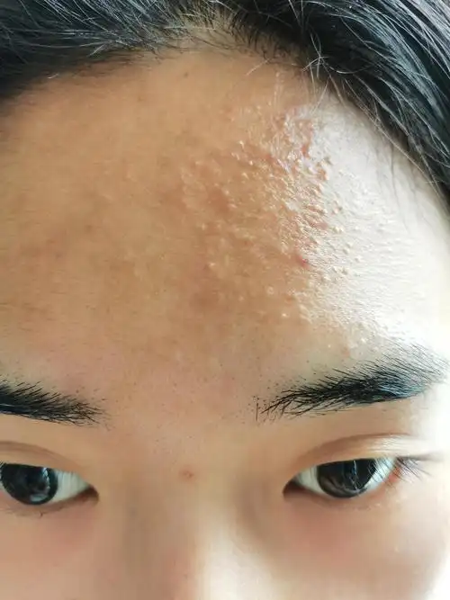 脸上长了好多闭口(慎入)
