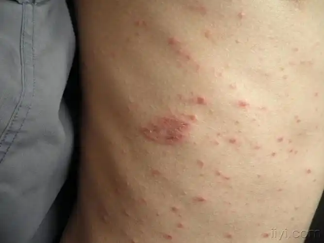 玫瑰糠疹的母斑