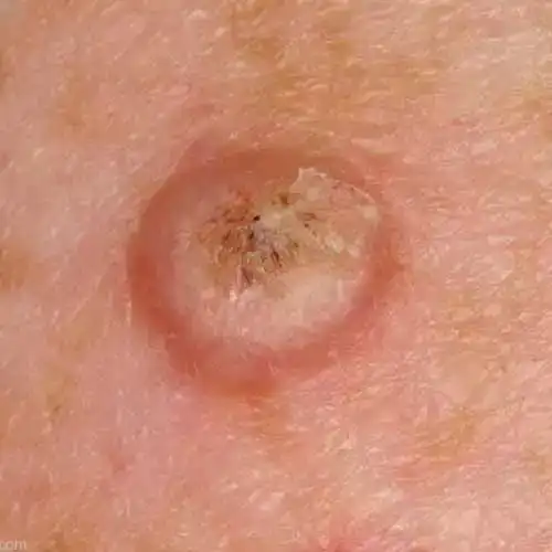 口腔鳞状细胞癌怎么治疗