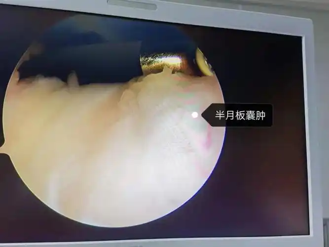 王先生经膝关节磁共振检查后提示:右膝内侧半月板后角撕裂,半月板囊肿