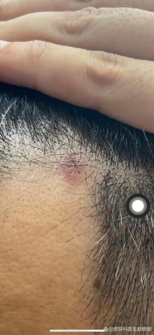 头皮的红斑,小心牛皮癣,可以做个皮肤镜看下