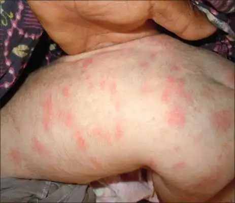 新生儿红斑图片50