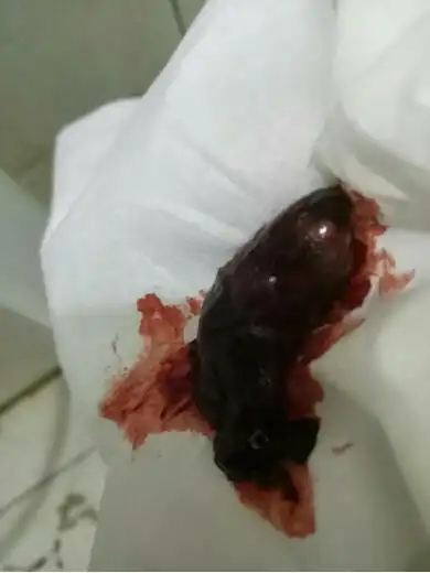 花了1800元,22天还在出血!去花溪中医院检查医生说