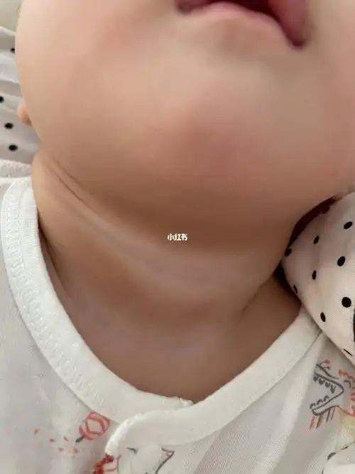 宝宝脖子肤色啥时候能均匀