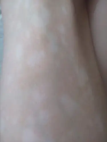 家里小朋友腿上和屁股上起了好多白斑,医生没法确诊是白癜风还是花斑