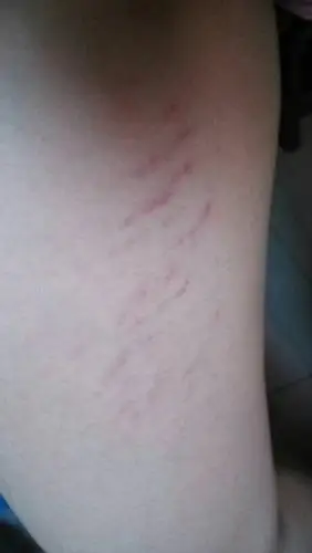 我今年15岁,最近压腿,腿上出现了一道道的红色血痕,是怎么了,该怎么办